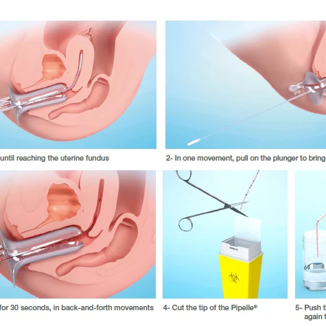 PIPELLE DE CORNIER sterile