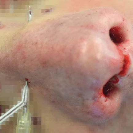 Haack adapter LuerLock skaft Ø2.35mm