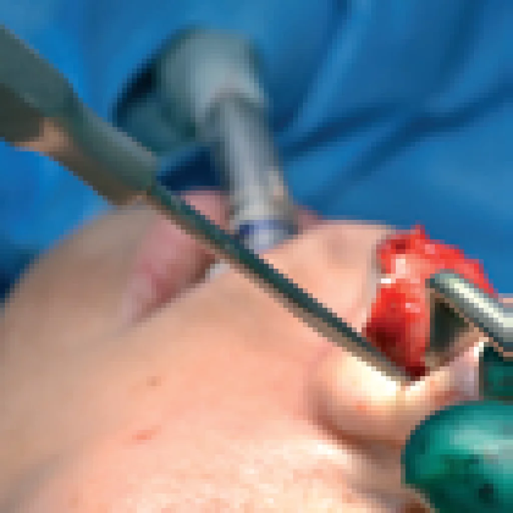 Daniel spina nasalis syl 16cm